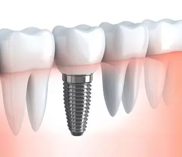 İmplant Tedavisi Hakkında Sıkça Sorulan Sorular: 2026