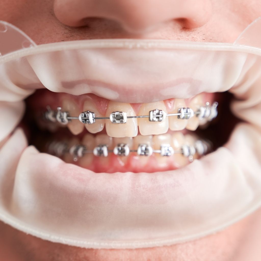 Ortodontik Diş Teli Elazığ Dentmaster Diş Kliniği