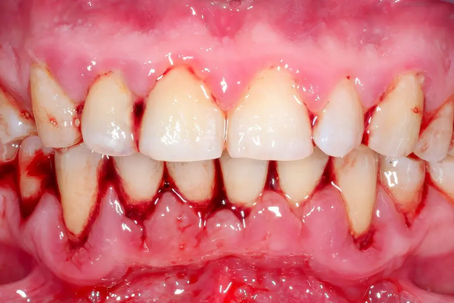 gingivitis