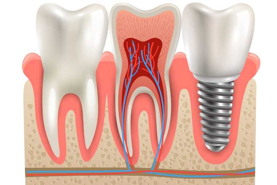İmplant Nedir?